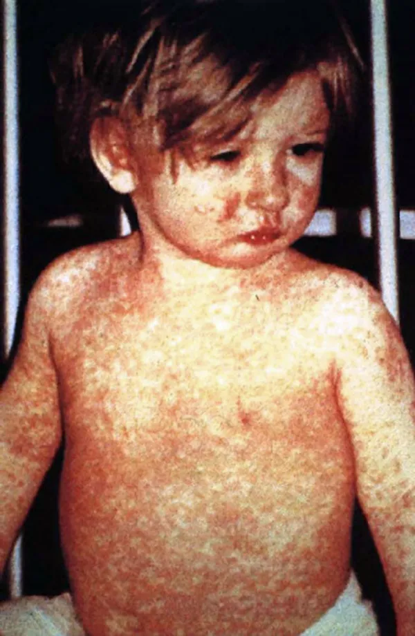 Oklahoma confirms measles case with potential exposure at Norman bar; health officials outline steps for contacts