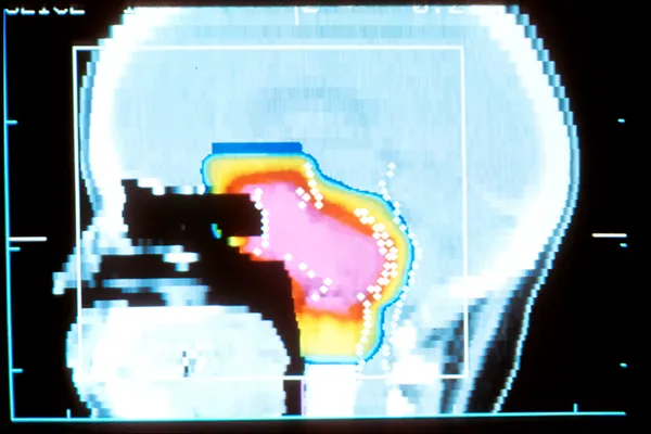 Phase III trial with OU participation links proton therapy to higher five-year survival in oropharyngeal cancer